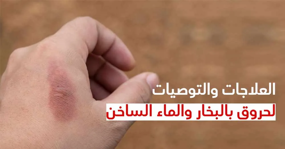 العلاجات والتوصيات لحروق بالبخار والماء الساخن